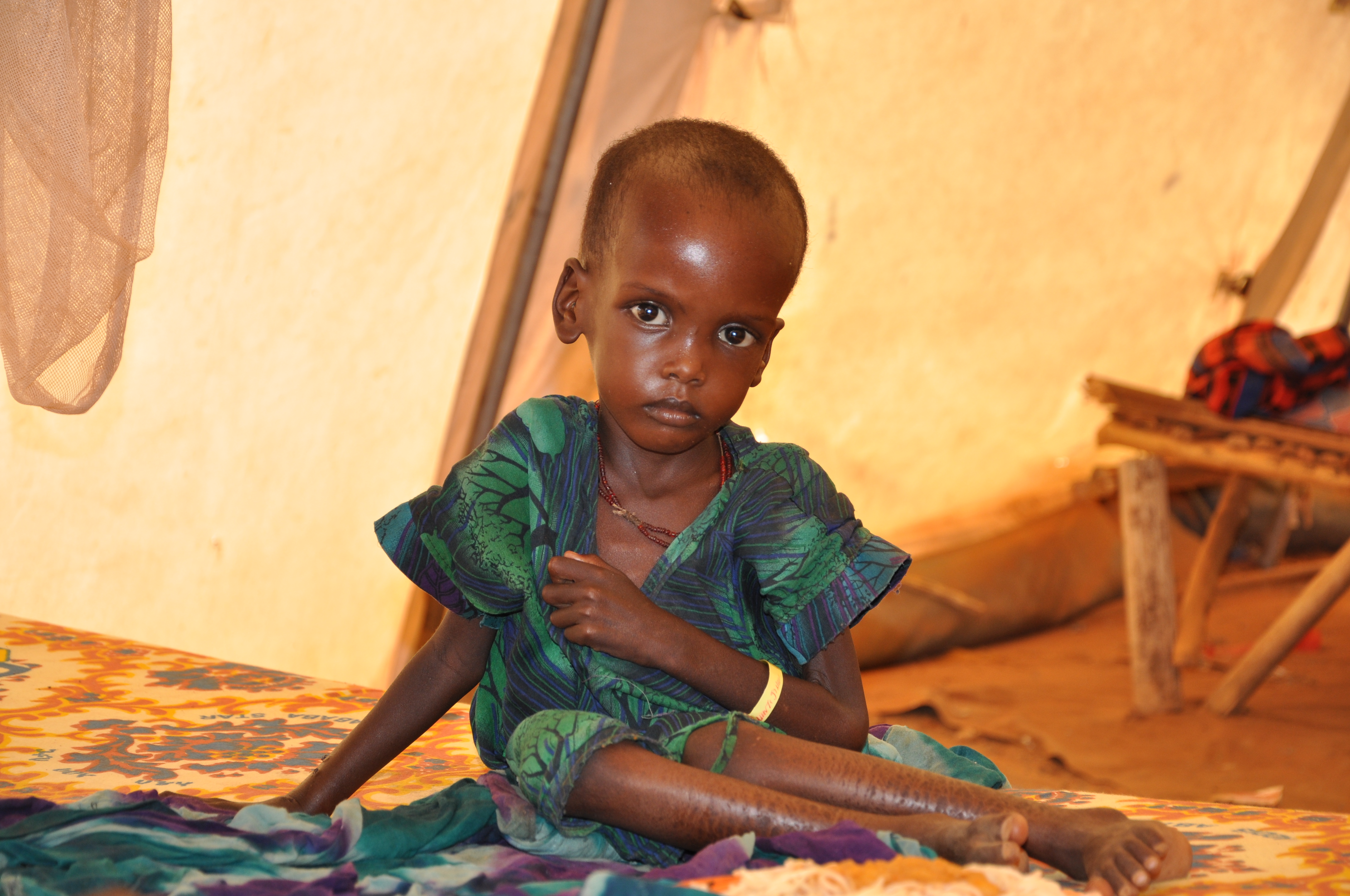 Malnourished child in Sierra Leone